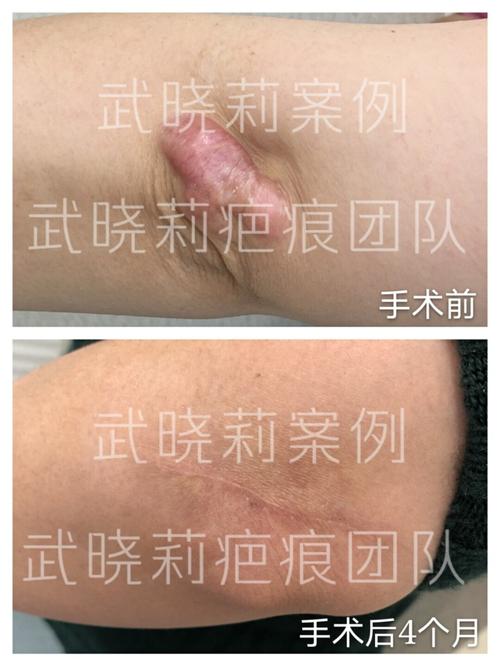 疤友笔记(24)肘部疤痕疙瘩超减张精细缝合术_疤痕_疤痕疙瘩_美妆_医美