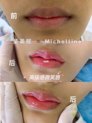 花瓣微笑唇_微笑唇_丰唇_唇形_设计_美妆_医美整形