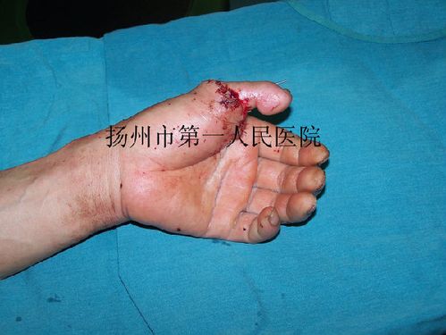 拇指再造(游离第二足趾移植)