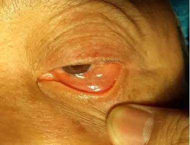 [眼肿瘤论坛]关注结膜囊肿的诊治