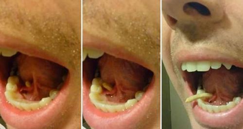 美男总觉得舌下肿胀,没想到舌头用力一推竟挤出近4公分的唾腺结石!