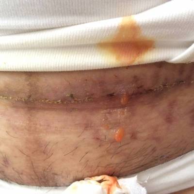 今天是刨腹产后第十四天,今早起来发现有一处刀口出脓