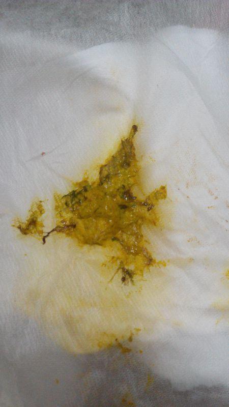 医生麻烦你看下这个新生儿大便,正常吗?刚