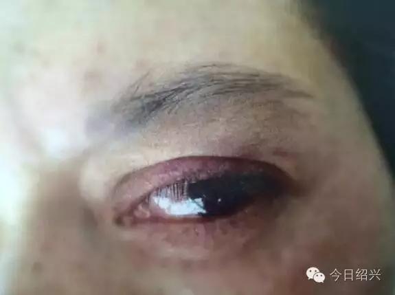 周女士受伤的眼睛