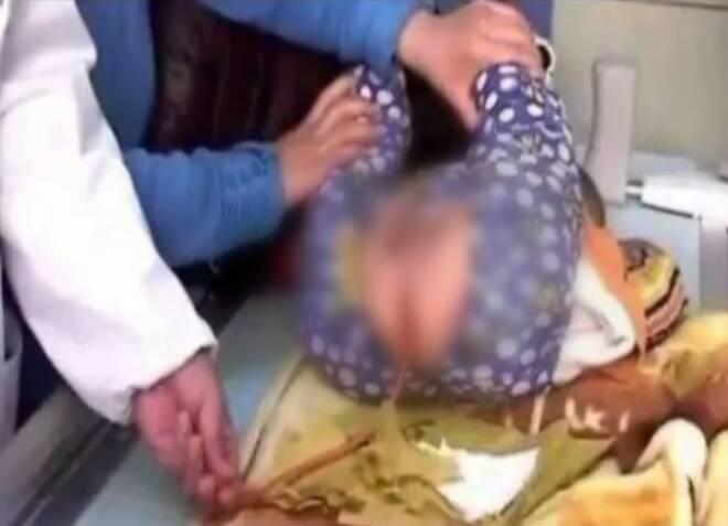 6个月宝宝高烧被"灌肠"退烧,退烧不成反肾衰,家人哭成