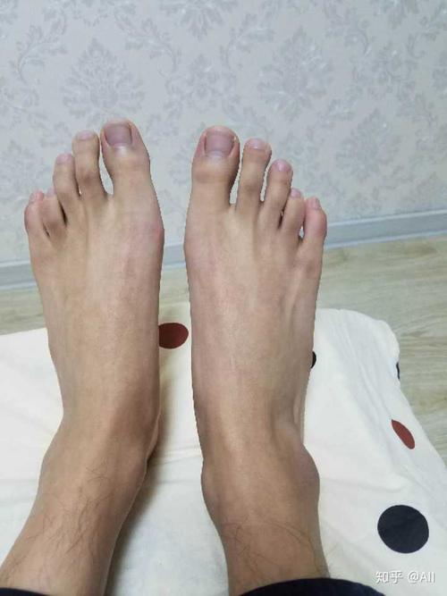 请问有人是第四脚趾短小症吗?