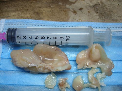 鼻息肉图片 (41)