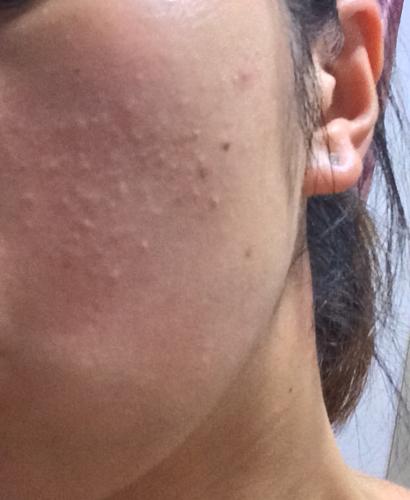 好多小痘痘怎么治,挤不出来,而且只有左半边脸有,右脸