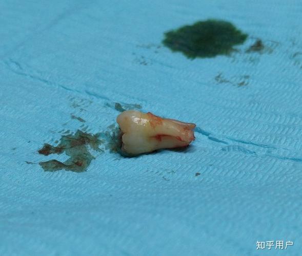 拔智齿需要多少钱?