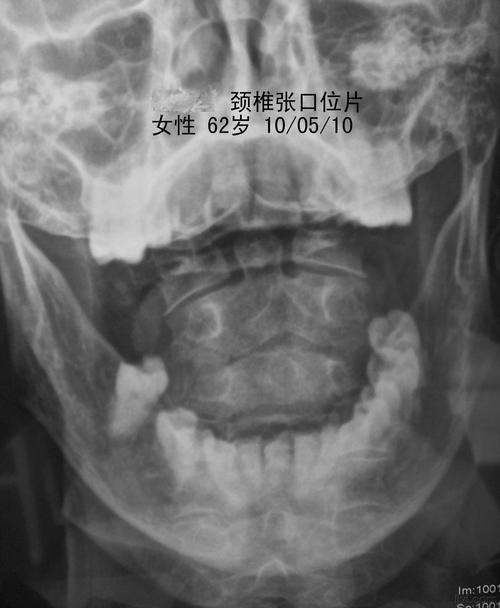 颈椎张口位片.jpg