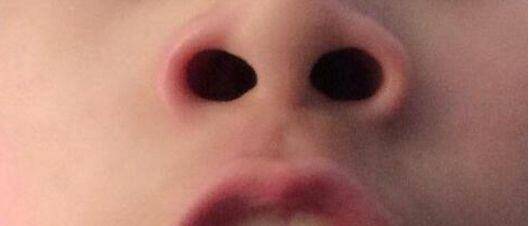 鼻孔霸气外露用这些方法解决它