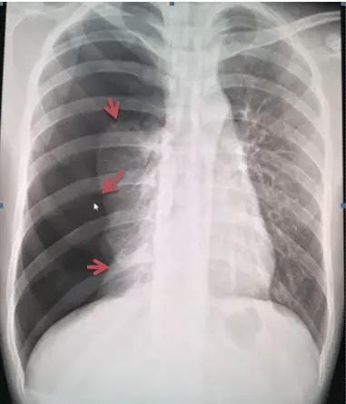 气胸的x线表现,6个病例帮你搞定