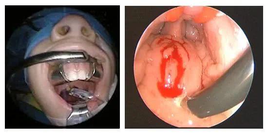 关于腺样体手术,您需要了解的都在这里