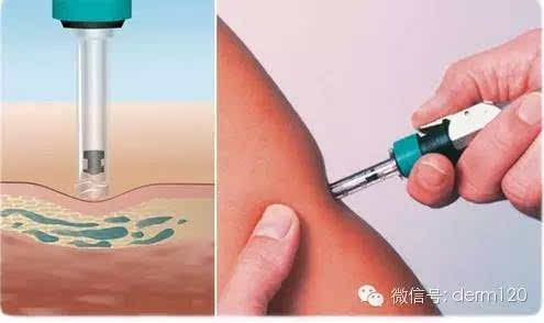 [医学]无针注射器是个什么鬼?
