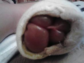 割包皮后水肿怎么办