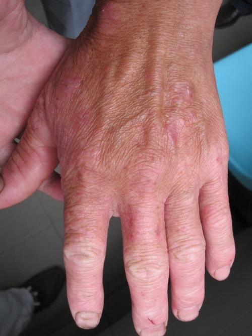 看图识病病例连载之13多形日光疹