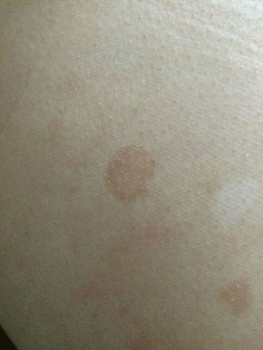 条回答  1 小时前 lwpfsz|来自:手机知道|六级 看着像花斑癣,也叫汗斑