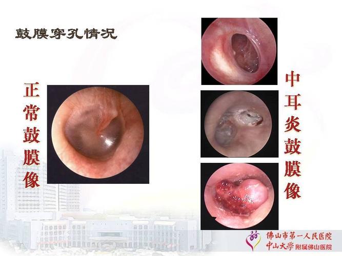 慢性化脓性中耳炎科普宣教