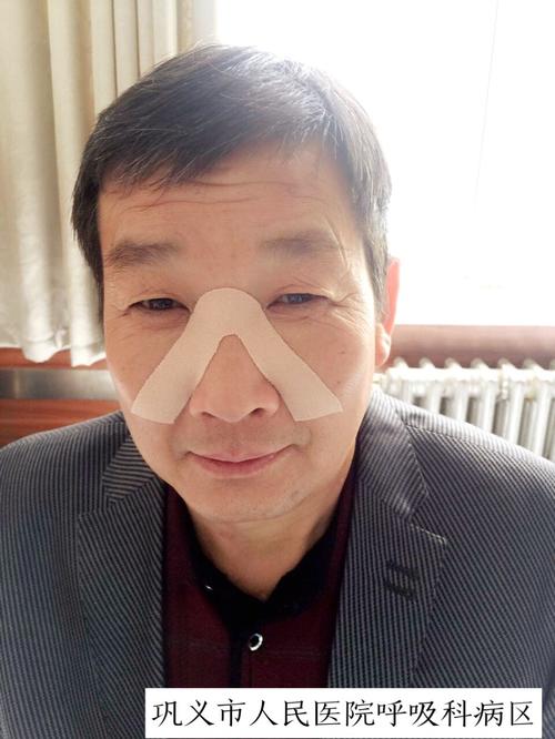 呼吸科服务创新——自制"鼻贴"