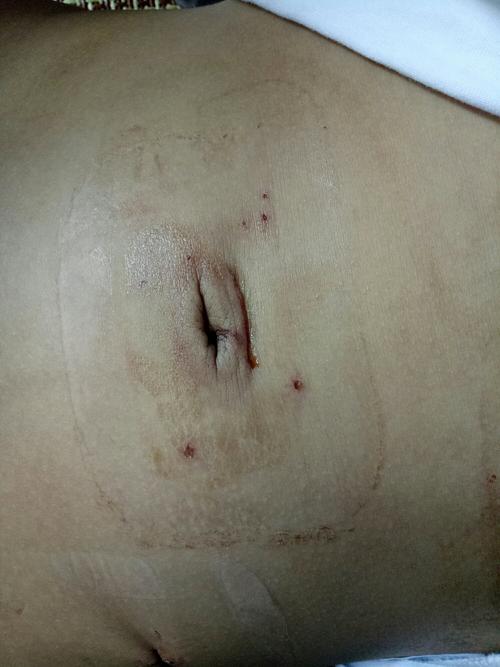 切口小,恢复快的腹腔镜阑尾炎手术