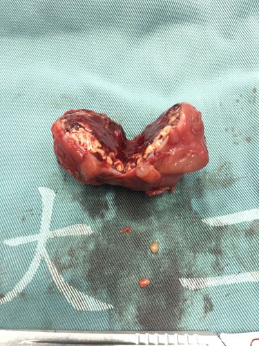 腹腔镜肾部分切除术治疗肾脏恶性肿瘤