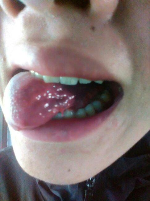 请问下大家 舌头上这个小肉须是什么