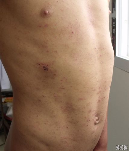 典型疥疮