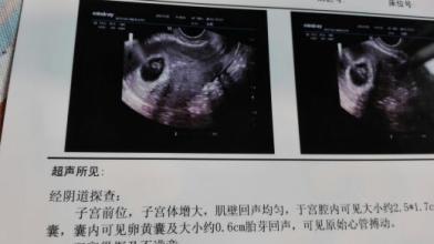 胎停一个月后才发现,一问原来是这个关键原因!