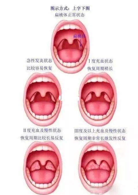 孩子脾胃是一切问题的根本_发炎_积食_扁桃体_肠道健康_咳嗽_调理脾胃
