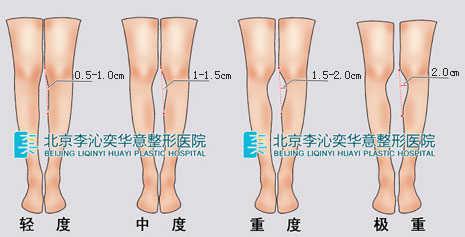 请问我这是o型腿吗?