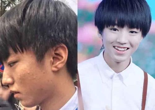 王俊凯素颜满脸痘痘太吓人!医生为你的战"痘"支招!