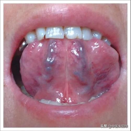 伸出舌头看看如果你的舌下是这样的要小心了