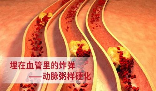 动脉硬化---血管里的炸弹