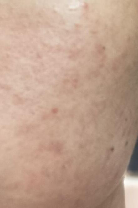 求助脸上这是痤疮吗