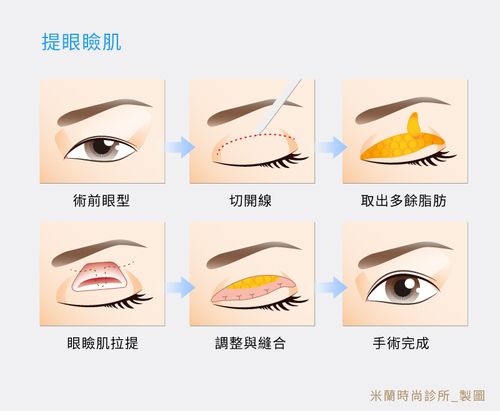 下垂程度 眼睑描述 下垂覆盖 示意图 【眼肌提升手术】 提升距离 距离