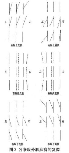 复像检查与分析  复视(diplopia)是病人最早的主诉症状,也是引发病人