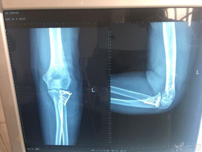 桡骨小头骨折手术治疗