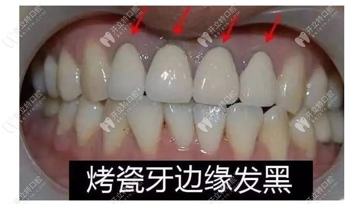 镍铬合金烤瓷牙这牙龈黑线确实有点不好看呢▼