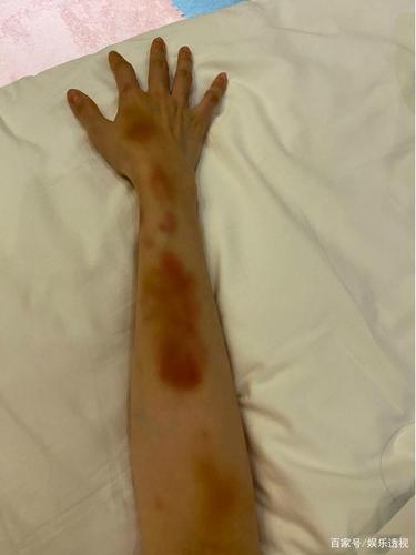 陈小纭获女子艺术体操冠军,手臂全是淤青,与张艺凡