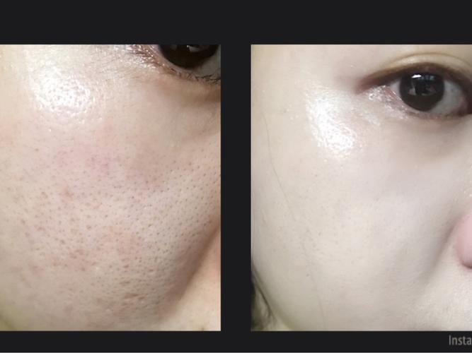 黑头清楚洗脸法」赶走黑头.毛孔.痘坑.痘印