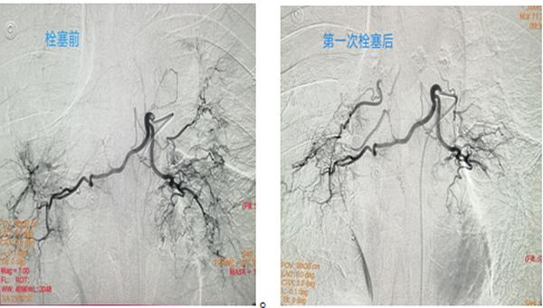 介入科成功栓塞复杂支气管动脉治疗大咯血