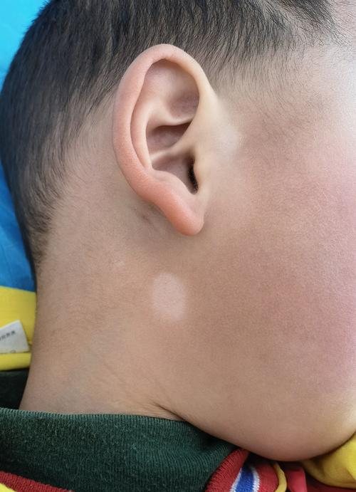 不说白不说系列白癜风高度模仿者之白色糠疹