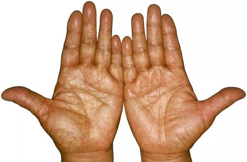 (胃癌患者手图)