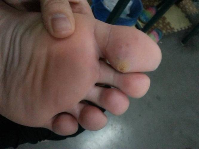 刚发现脚指头长了好多一颗颗小小的透明的硬性的类似痘痘的东西不痒