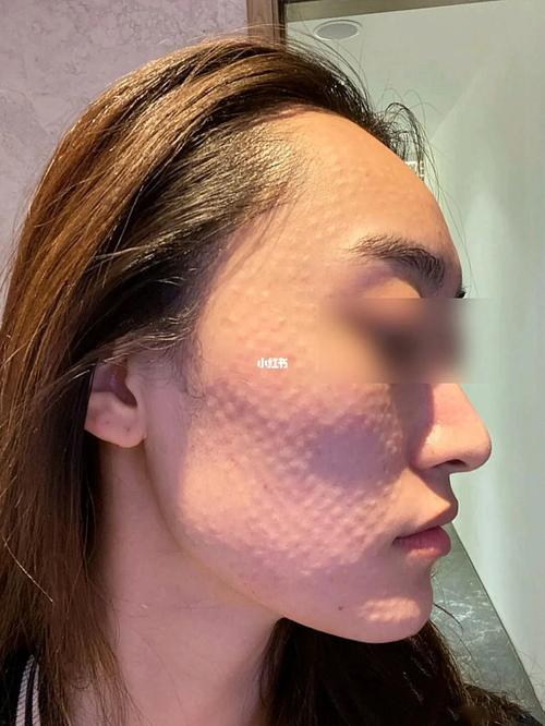 打完水光针后出现皮丘正常吗?_水光针_补水_医用面膜