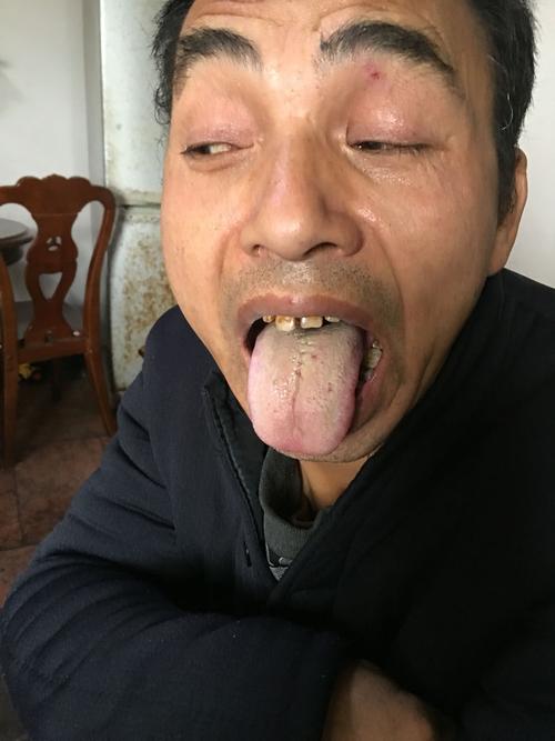 我爸爸肝转移癌晚期,前期一直拉不出大便,借助中药调