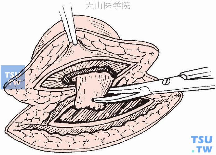 【图】脐疝修补术 - 外科手术学 - 天山医学院