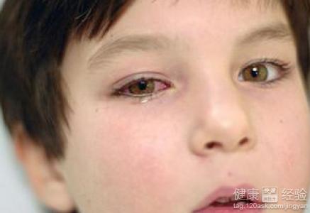 沙眼和结膜炎的区别是什么