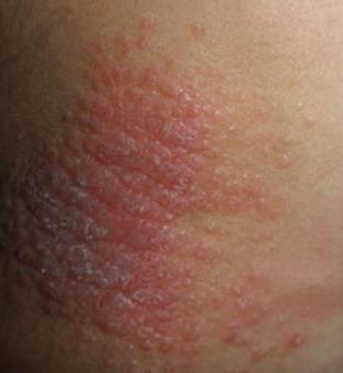 3招让神经性皮炎不再反反复复