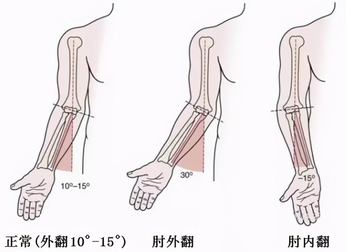 时,前臂轴线与上臂轴线,并不在一条直线上,而是会形成一定外翻角度